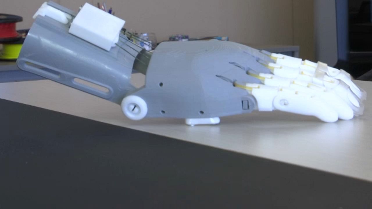 Medical Students Create 3DPrinted Prosthetic