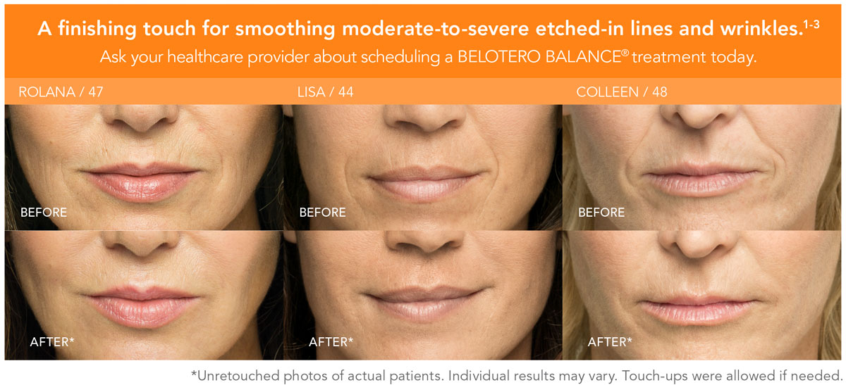 Belotero Specialist Lauderhill, FL Strax Rejuvenation Plastic Surgeon