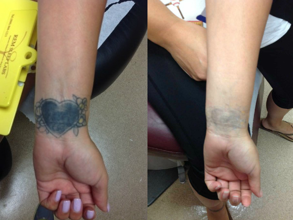 Tattoo Removal Services in Los Angeles Renee Patel, M.D