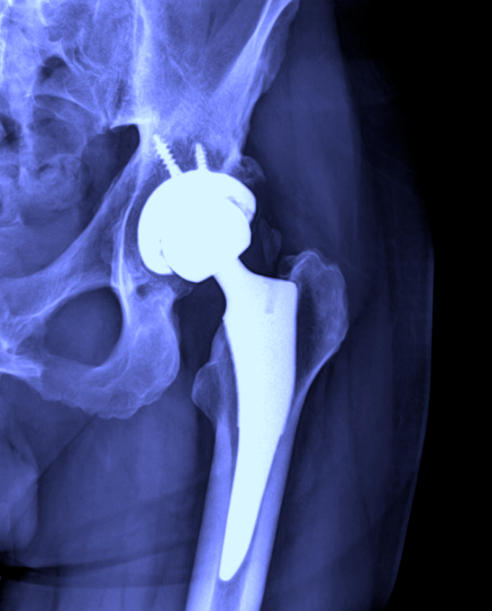 Total Joint Replacement Specialist Austin, TX Greater Austin