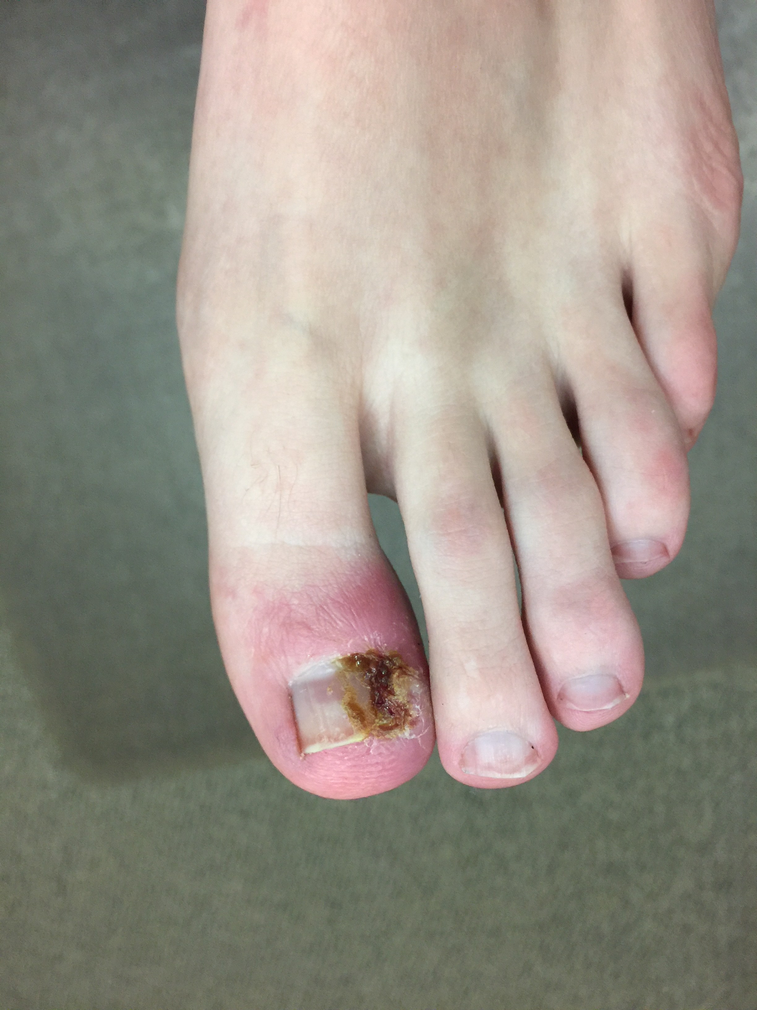 Ingrown Toenails Hagerstown, MD & Frederick, MD Reconstructive Foot