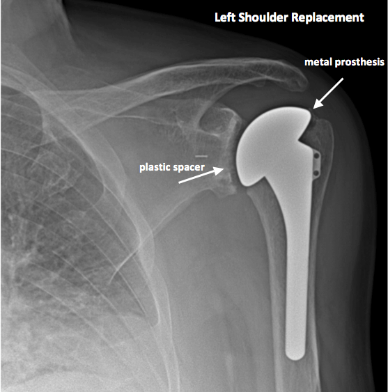 Shoulder Xray Century City Los Angeles, CA Millstein Orthopedics