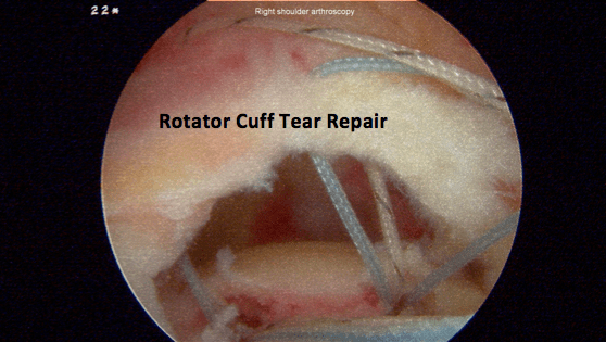 Shoulder Arthroscopy Century City Los Angeles, CA Millstein Orthopedics