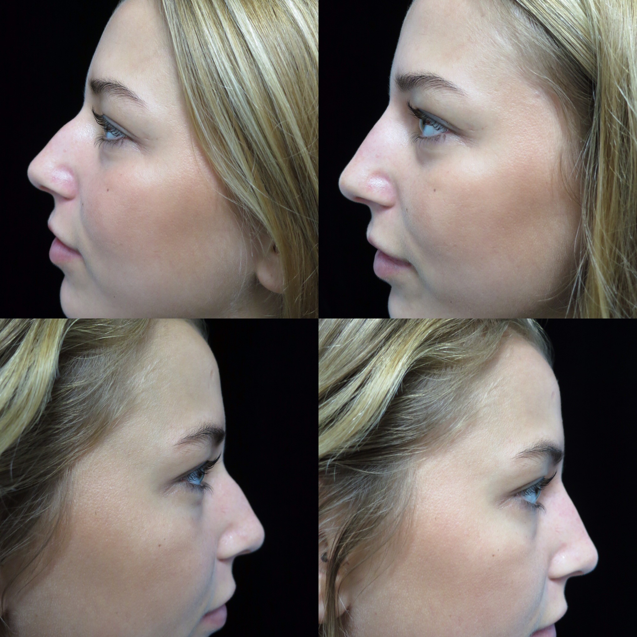 10 Minute Non Surgical (Liquid) Rhinoplasty By Dr. Deepak Dugar