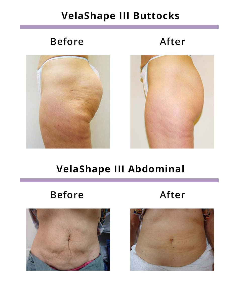 Velashape 3 Results