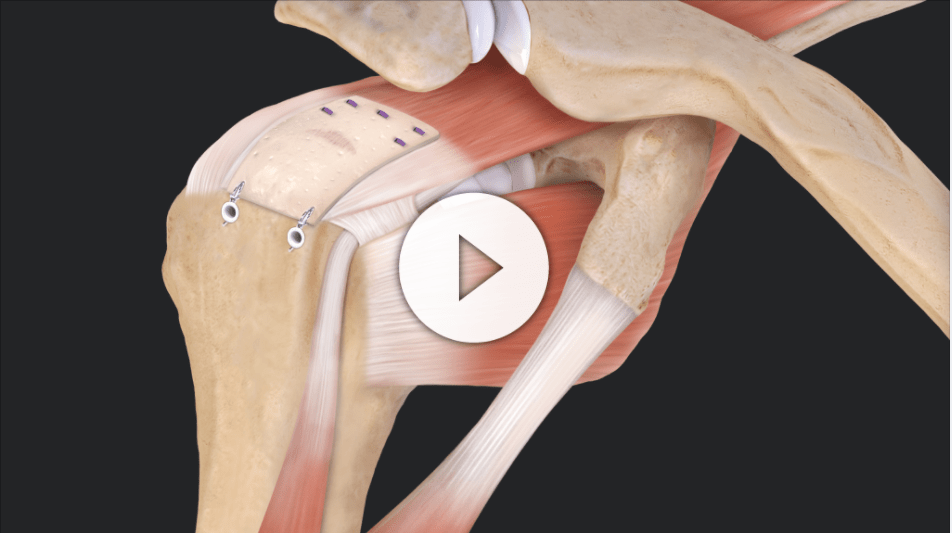 Rotator Cuff Repair Dublin, OH Advantage Orthopedics Orthopedic