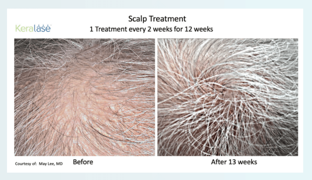 KeraLase Hair Loss Treatment Lawrence Township, NJ Sleep and
