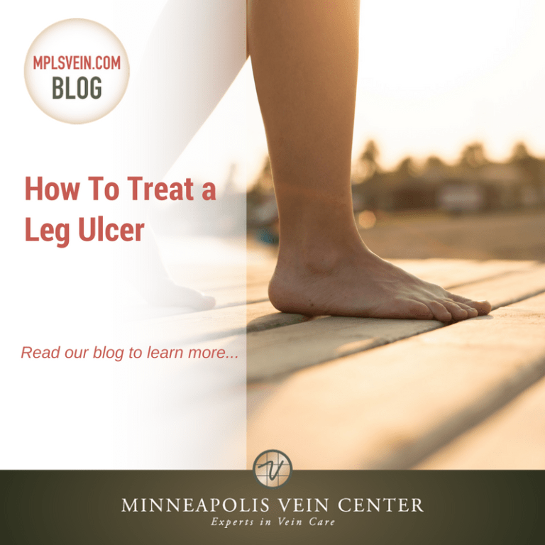 How To Treat a Leg Ulcer Minneapolis Vein Center Interventional