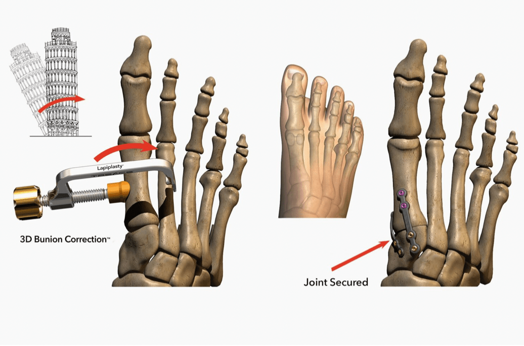 Lapiplasty Bunion Correction Specialists North Florida Gainesville