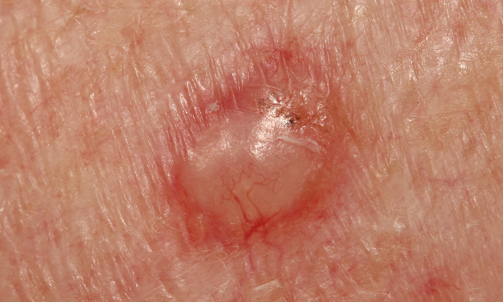 Basal Cell Carcinoma (BCC) for Cumming, Dawsonville, Dahlonega, Toccoa