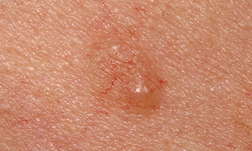 Basal Cell Carcinoma (BCC) for Cumming, Dawsonville, Dahlonega, Toccoa
