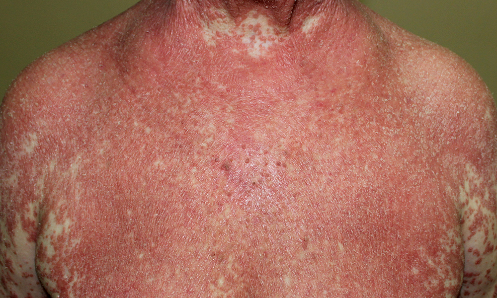 Psoriasis for Cumming, Dawsonville, Dahlonega, Toccoa, Canton, Johns