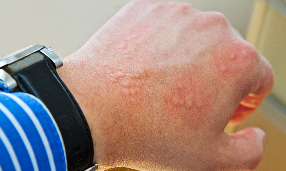 Eczema for Cumming, Dawsonville, Dahlonega, Toccoa, Canton, Johns Creek