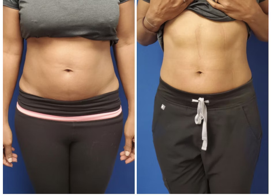 Body Contouring PHYSIQ Boynton Beach, FL Premier Dermatology Partners® Dermatologist