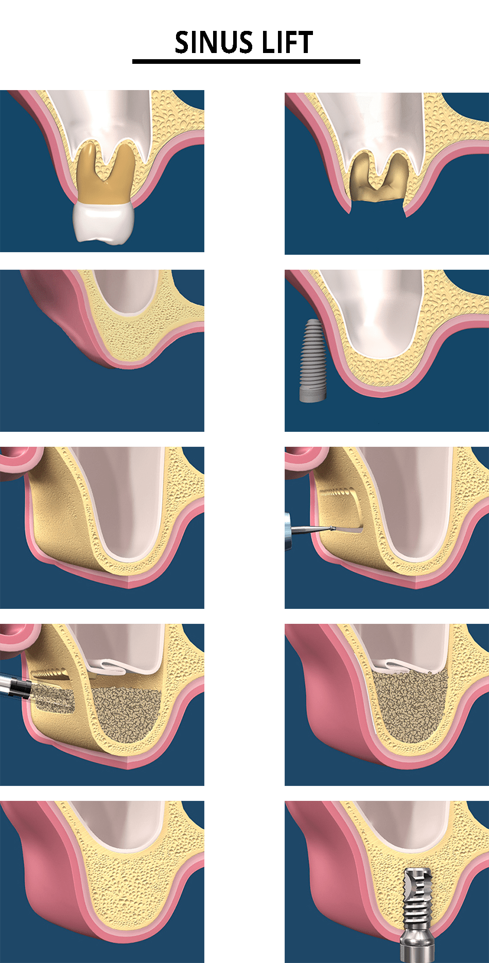 Sinus Lift Specialist Danville, CA Kian Farzaneh, DDS Oral Surgeon
