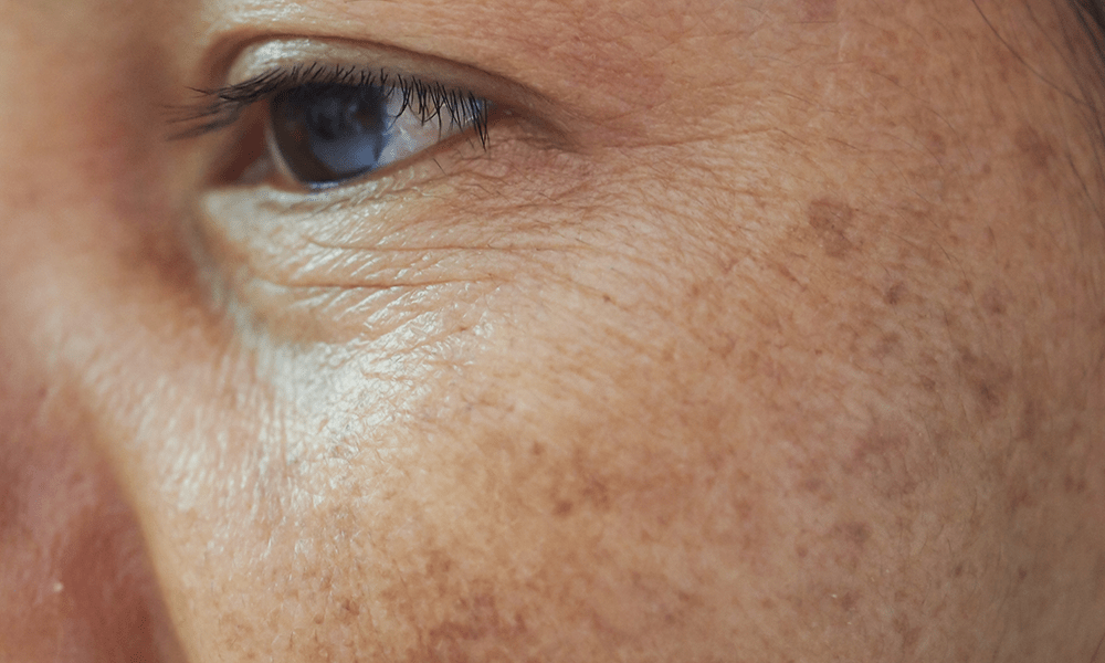 Sun Damage and Sun Spots Medical Aesthetics & Wellness Center located in Scottsdale, AZ