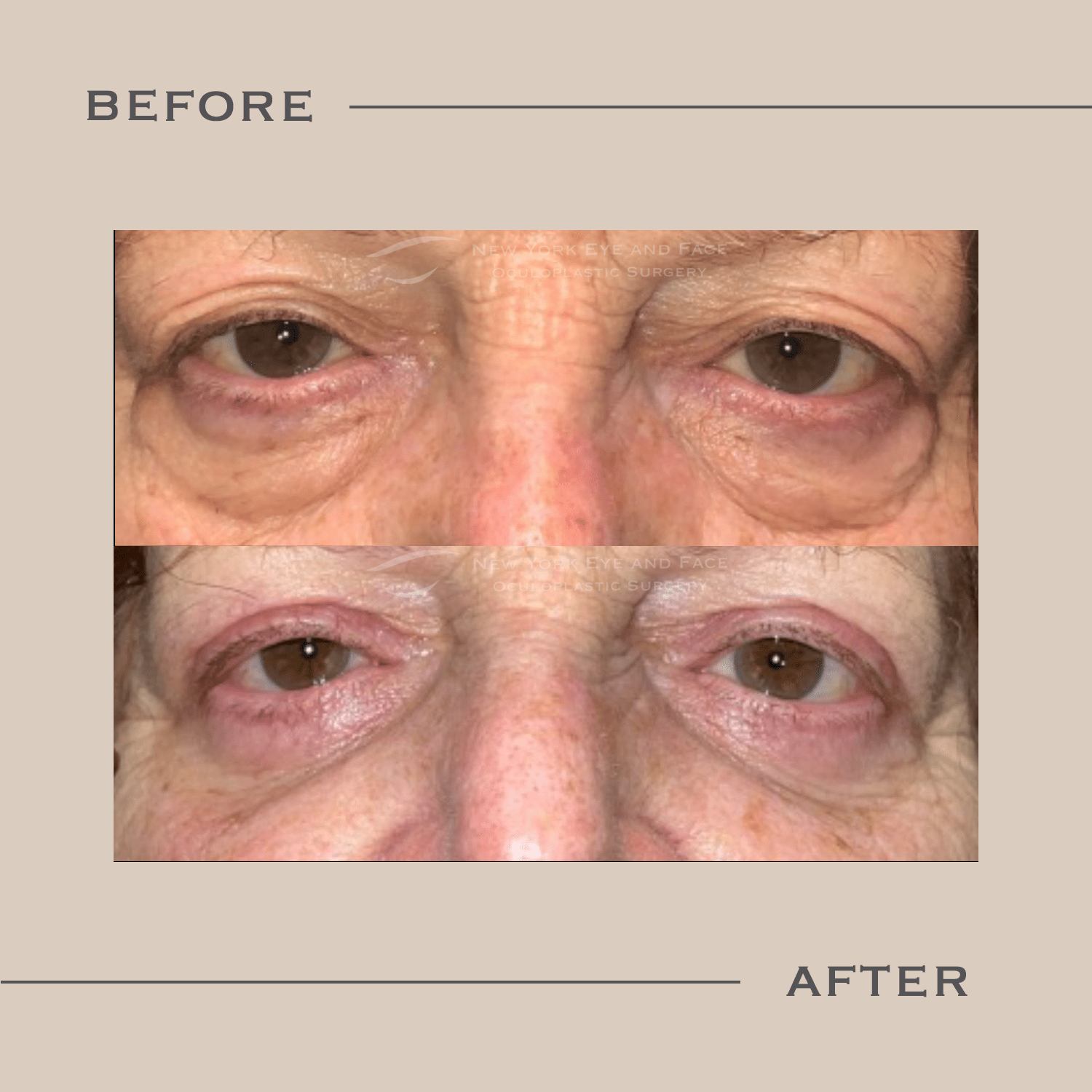 Lower Blepharoplasty Gallery West Harrison, NY New York Eye and Face Oculoplastic Surgery