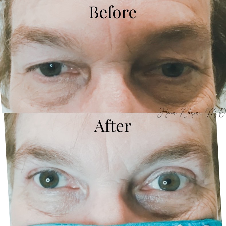 Eyelid Surgery McKinney, TX Texas Eye Doctors Comprehensive