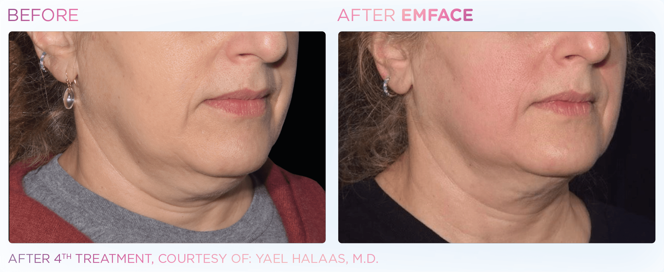 EMFACE Raleigh, NC Glo de Vie Med Spa Med Spa