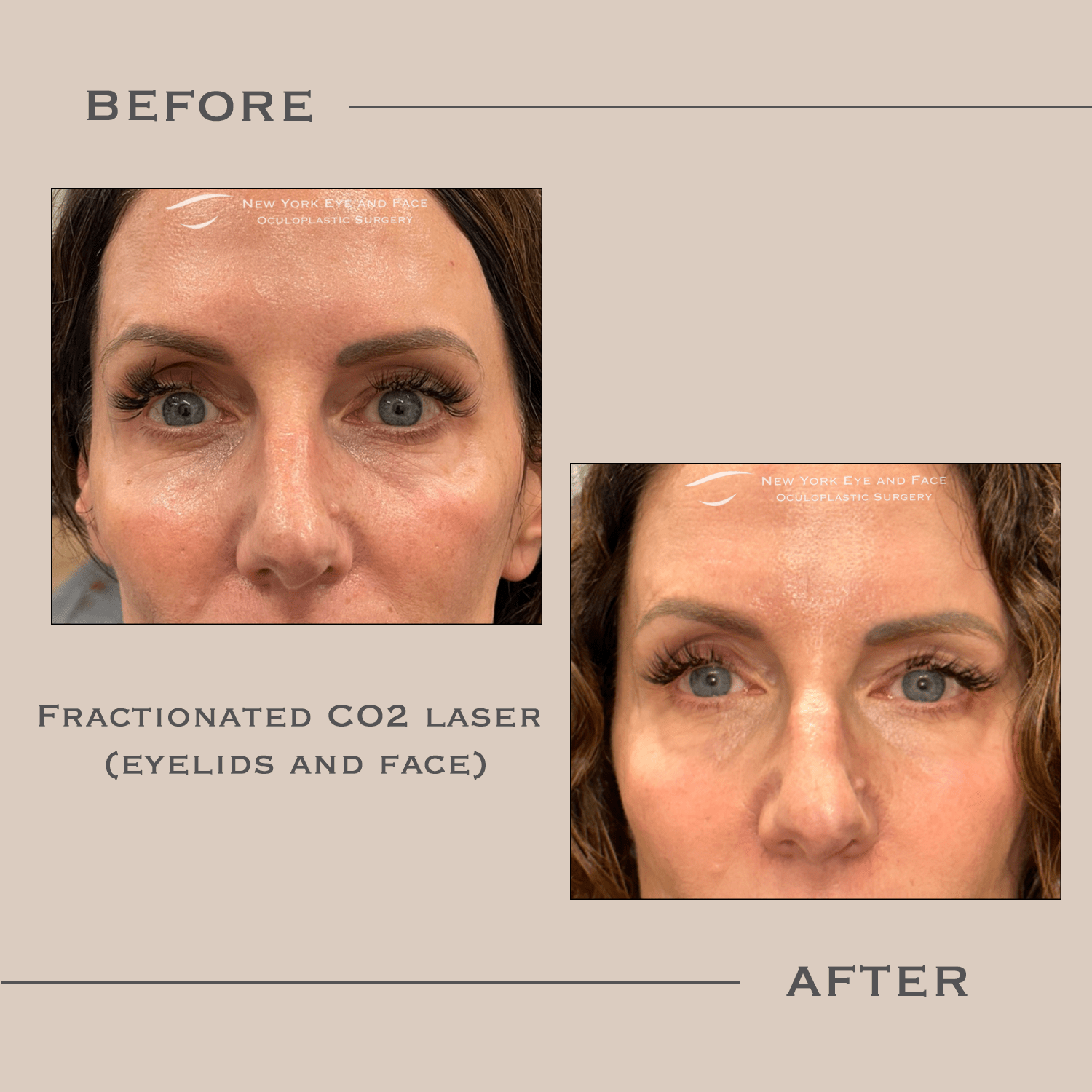 AcuPulse CO2 Laser West Harrison, NY New York Eye and Face
