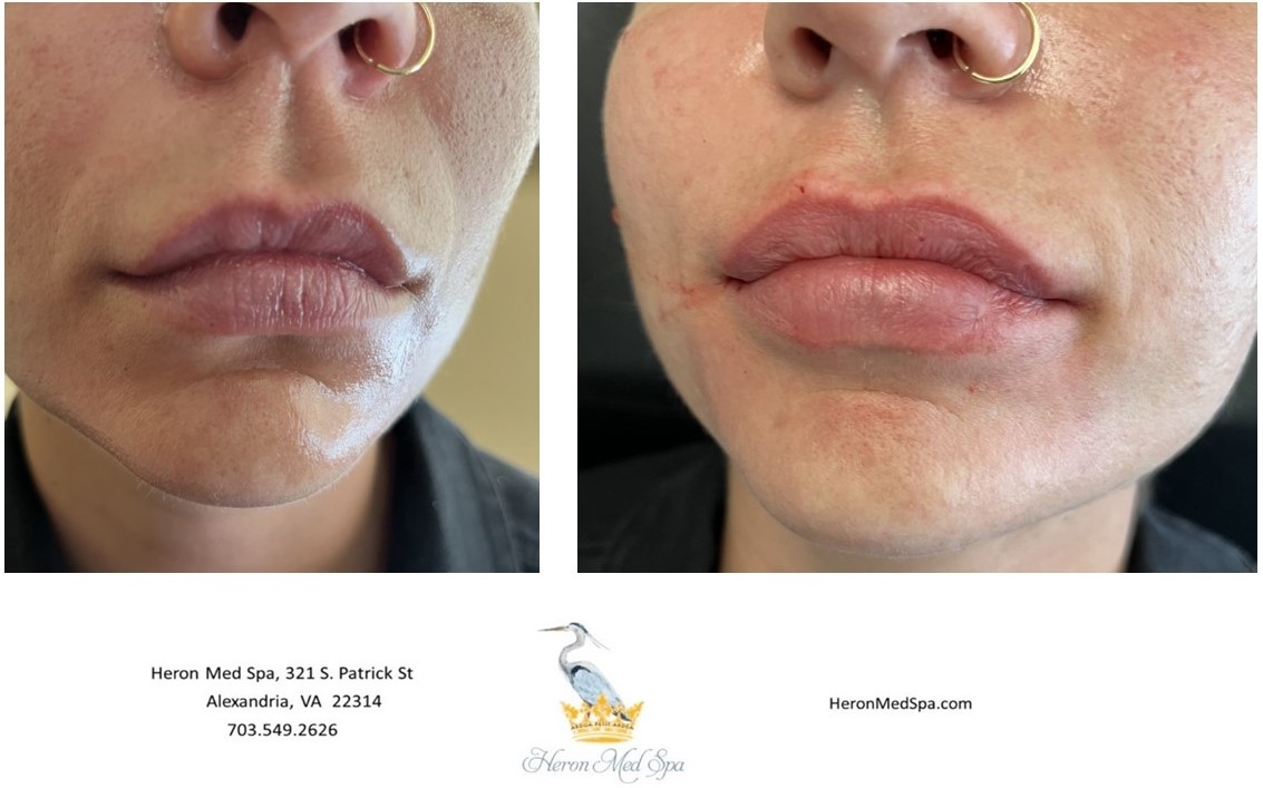 Antiaging Alexandria, VA Heron Med Spa