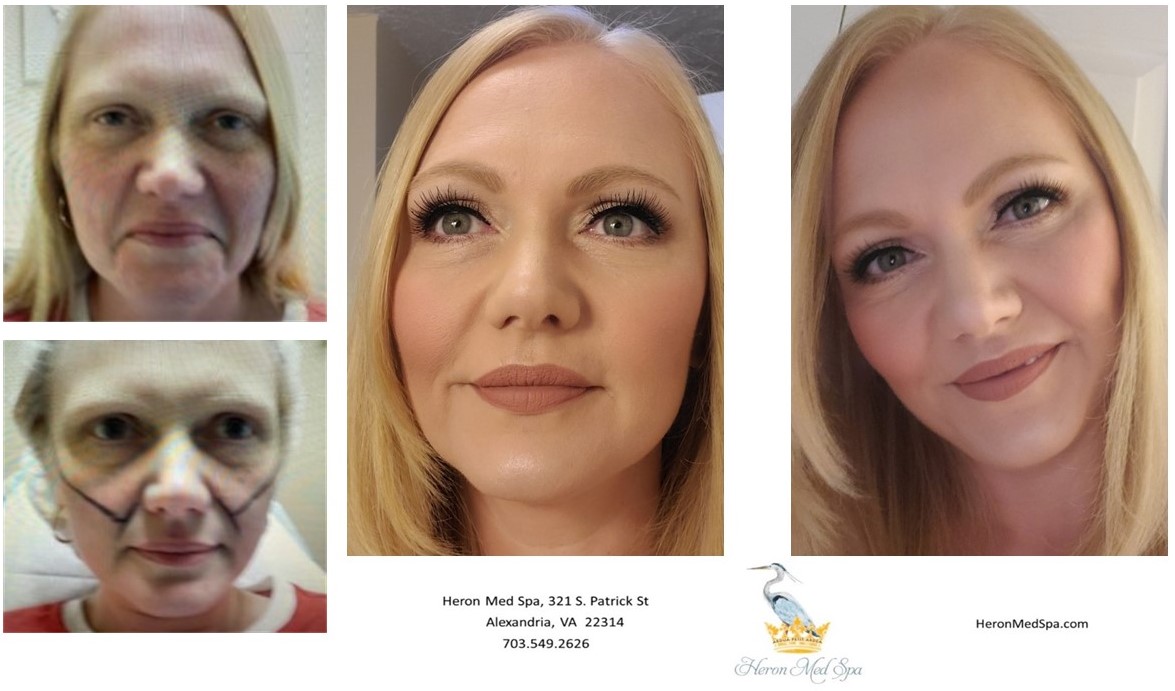 Antiaging Alexandria, VA Heron Med Spa