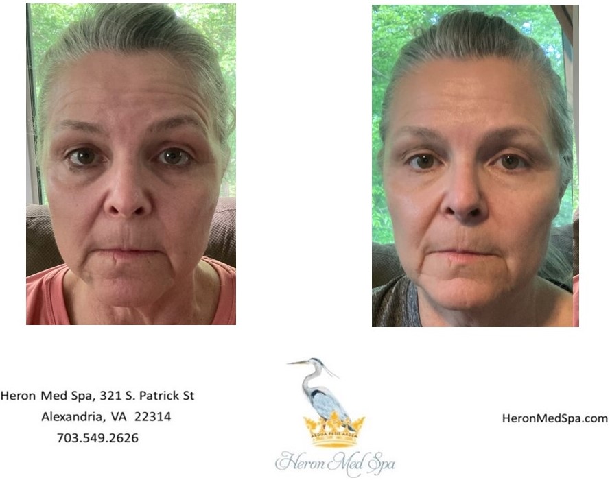 Antiaging Alexandria, VA Heron Med Spa