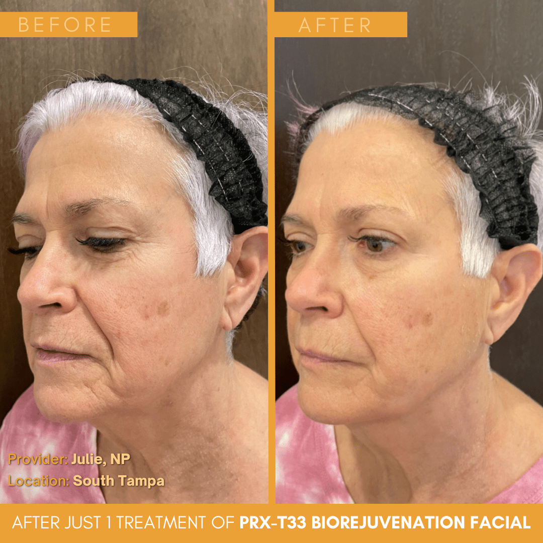 Skin Rejuvenation for Tampa, Riverview and Palm Harbor, FL Garcia