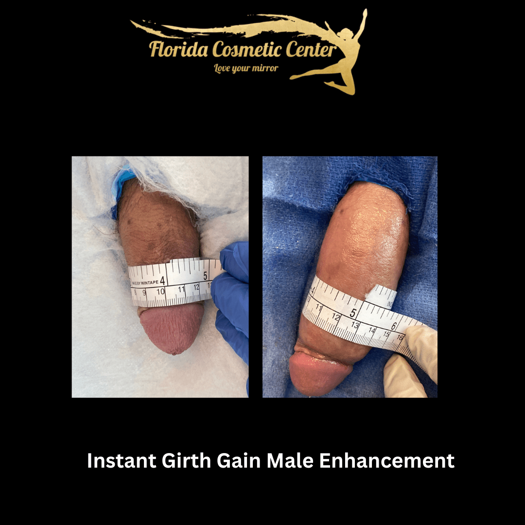 PRP And Filler Instant Penis Augmentation Specialist Lakeland, FL