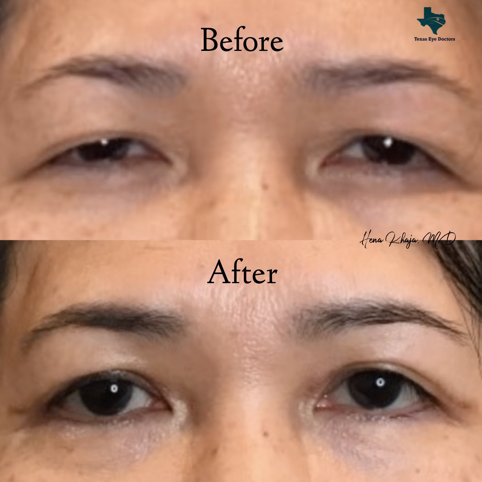 Eyelid Surgery McKinney, TX Texas Eye Doctors Comprehensive