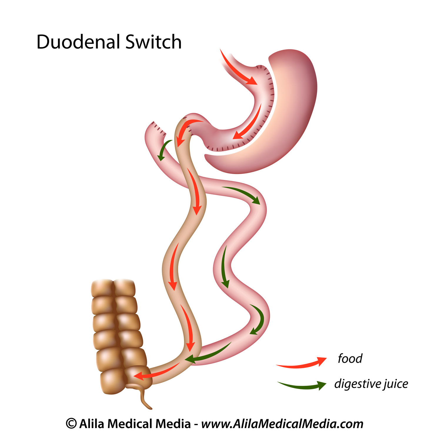 Duodenal Switch Frisco, TX The Bariatric Experts™ Bariatric and