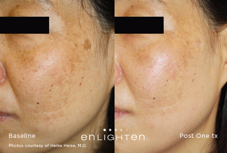 Pico Genesis To Treat Melasma And Pigments Specialist Orange County