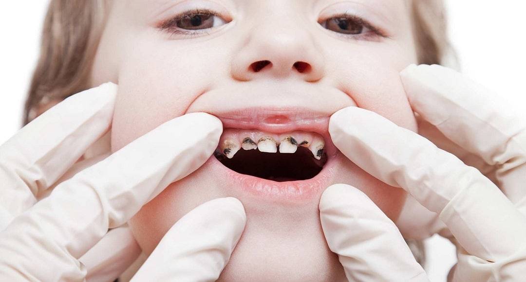 Oral Health Tooth Decay Treatment
