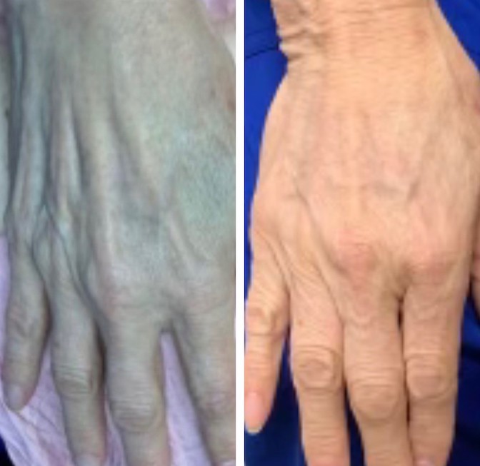 Restylane, Lyft, Defyne, Refyne, and Kysse Dermatologist In Lake