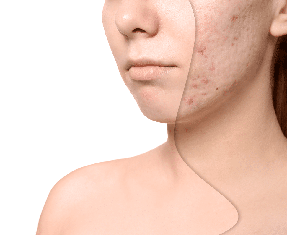 Acne Scars Treatments in Singapore S Aesthetics Clinic Singapore
