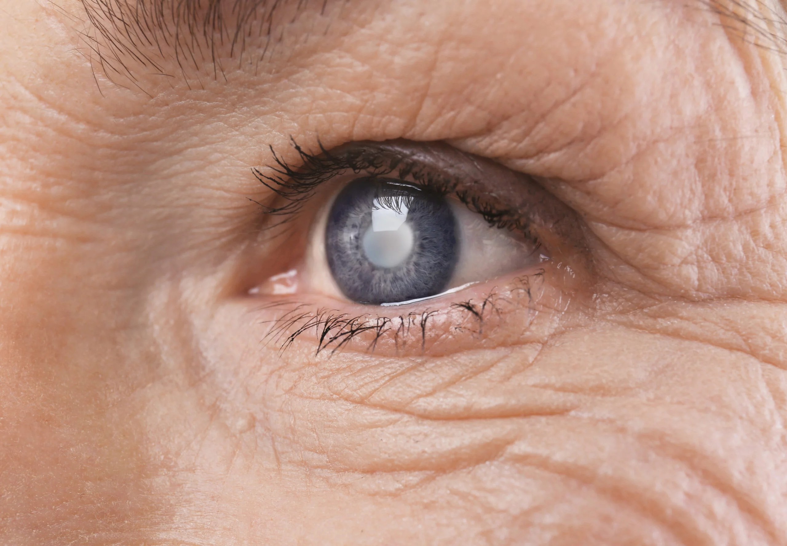 All You Need to Know About Cataracts SafeVision
