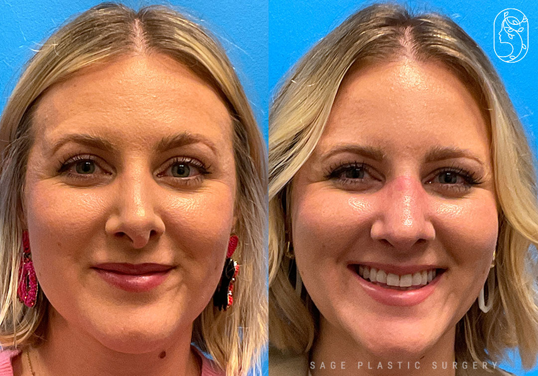 Rhinoplasty Dallas TX Sage Plastic Surgery