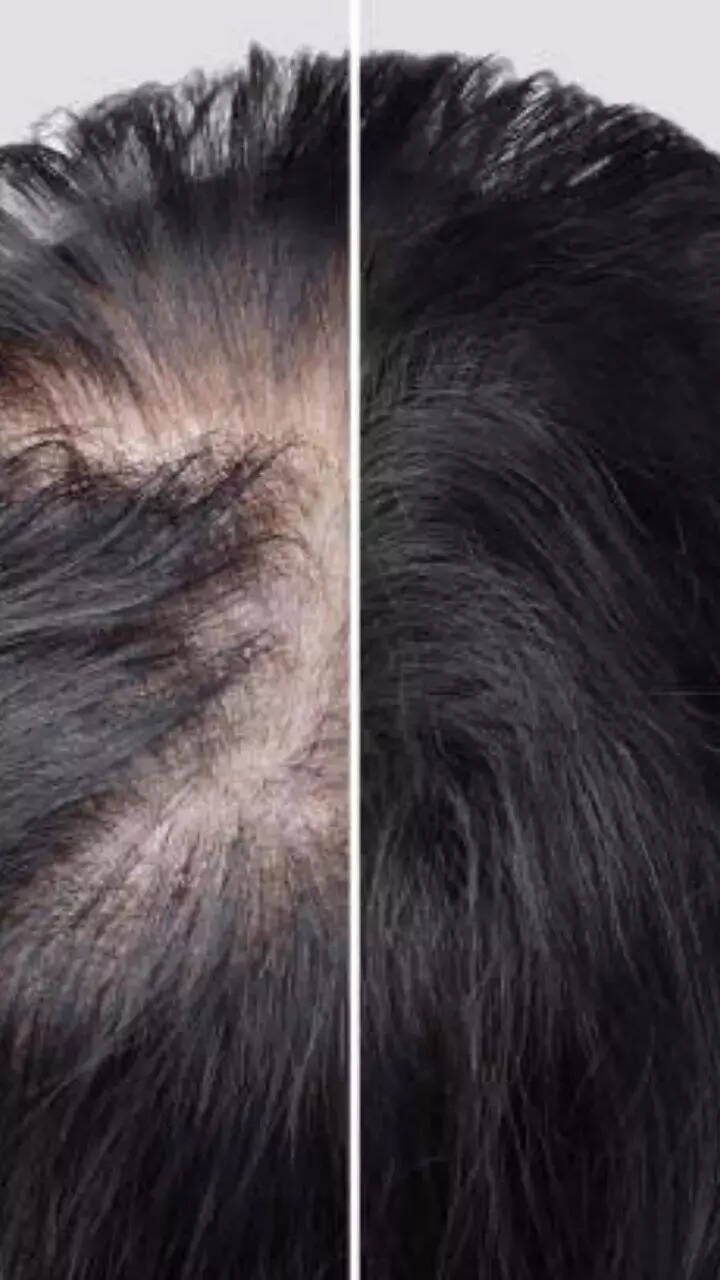 How to massage bald spots with oil for quick hair regrowth How to massage bald spots with oil for quick hair regrowth