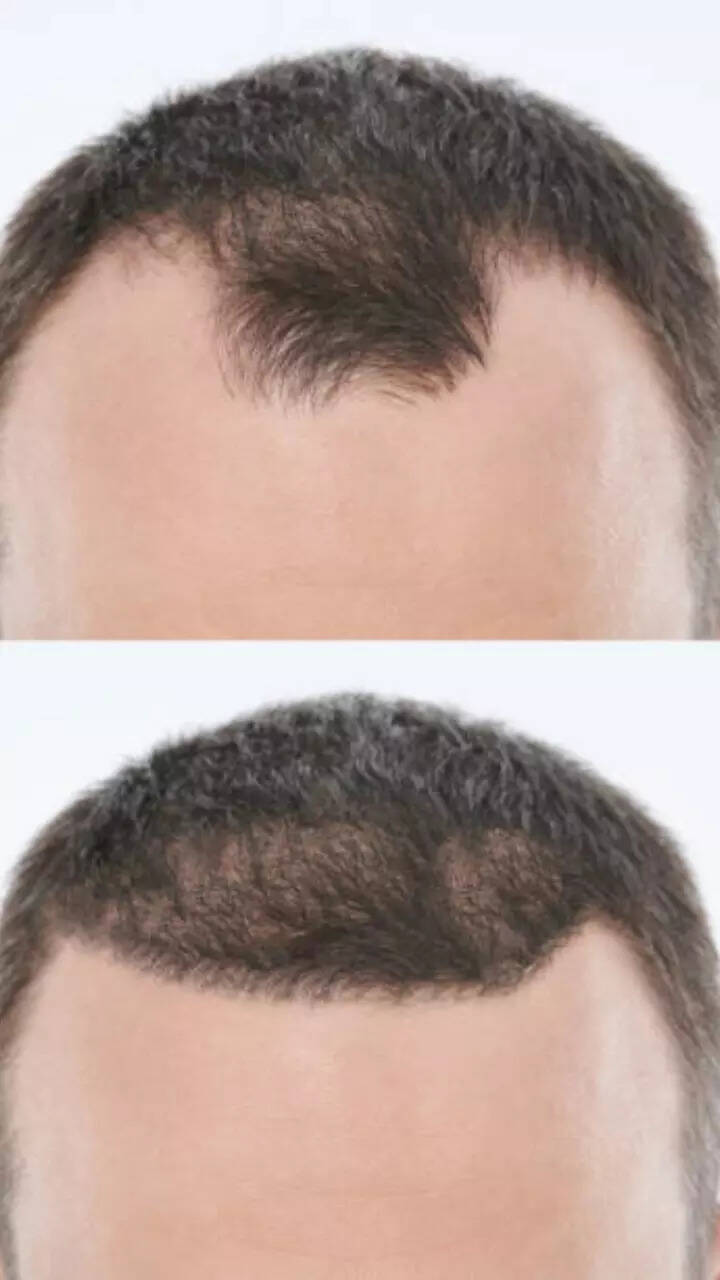 7 foods that can help prevent hair loss 7 foods that can help prevent hair loss