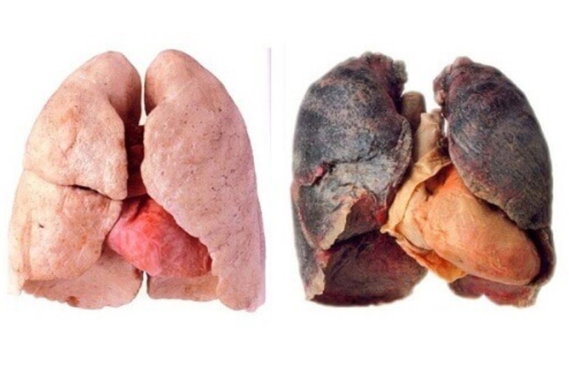 Tandatanda Awal Kanser ParuParu Pada Lelaki Dan Wanita