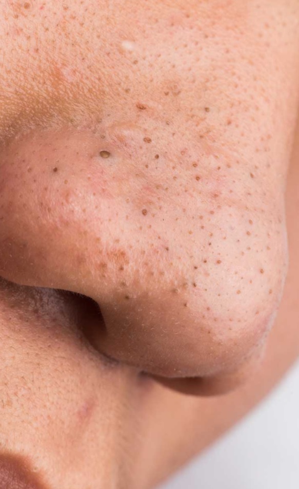 Petua Cara Hilangkan Blackhead Guna Dua Bahan Mudah Ini