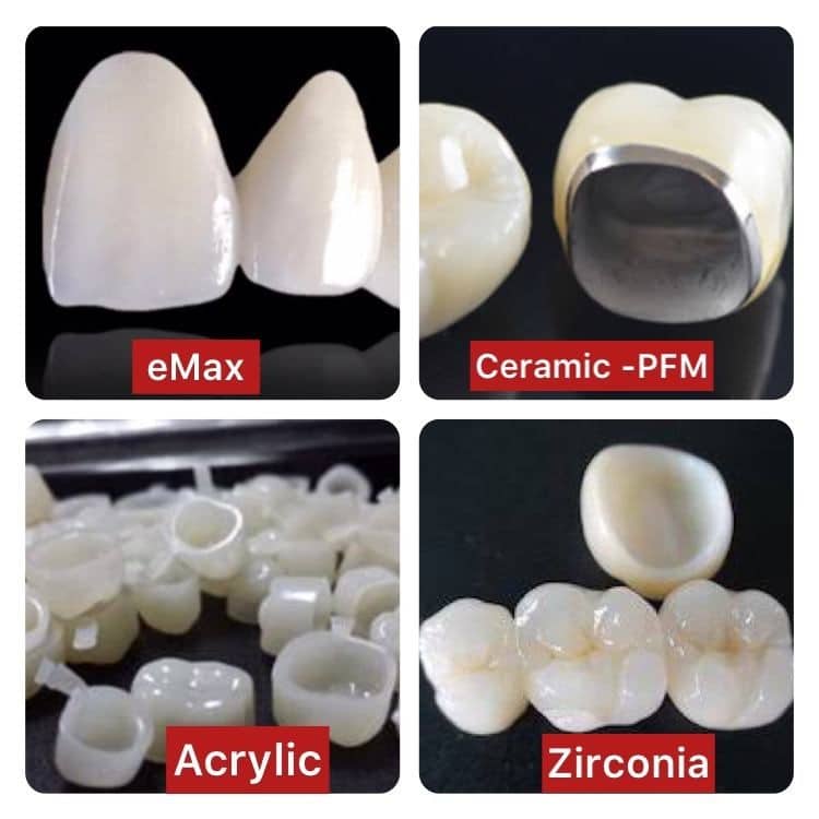 எந்த மாதிரி செயற்கை பல் ( பல் Cap ) Best னு தெரிஞ்சுக்கணுமா ? Which