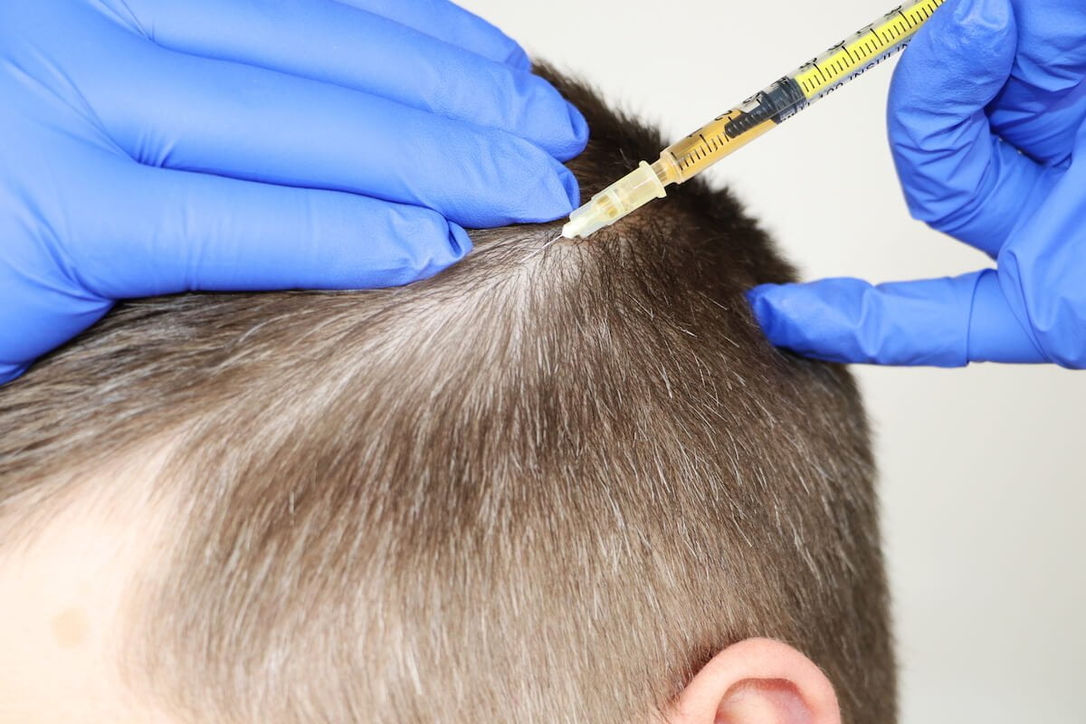 Best Hair Loss Treatment for Men vs. Women Salameh Plastic Surgery Center