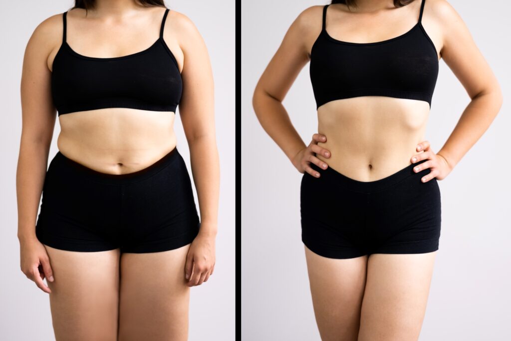 Do I Need a Tummy Tuck or Liposuction? Salameh Plastic Surgery Center