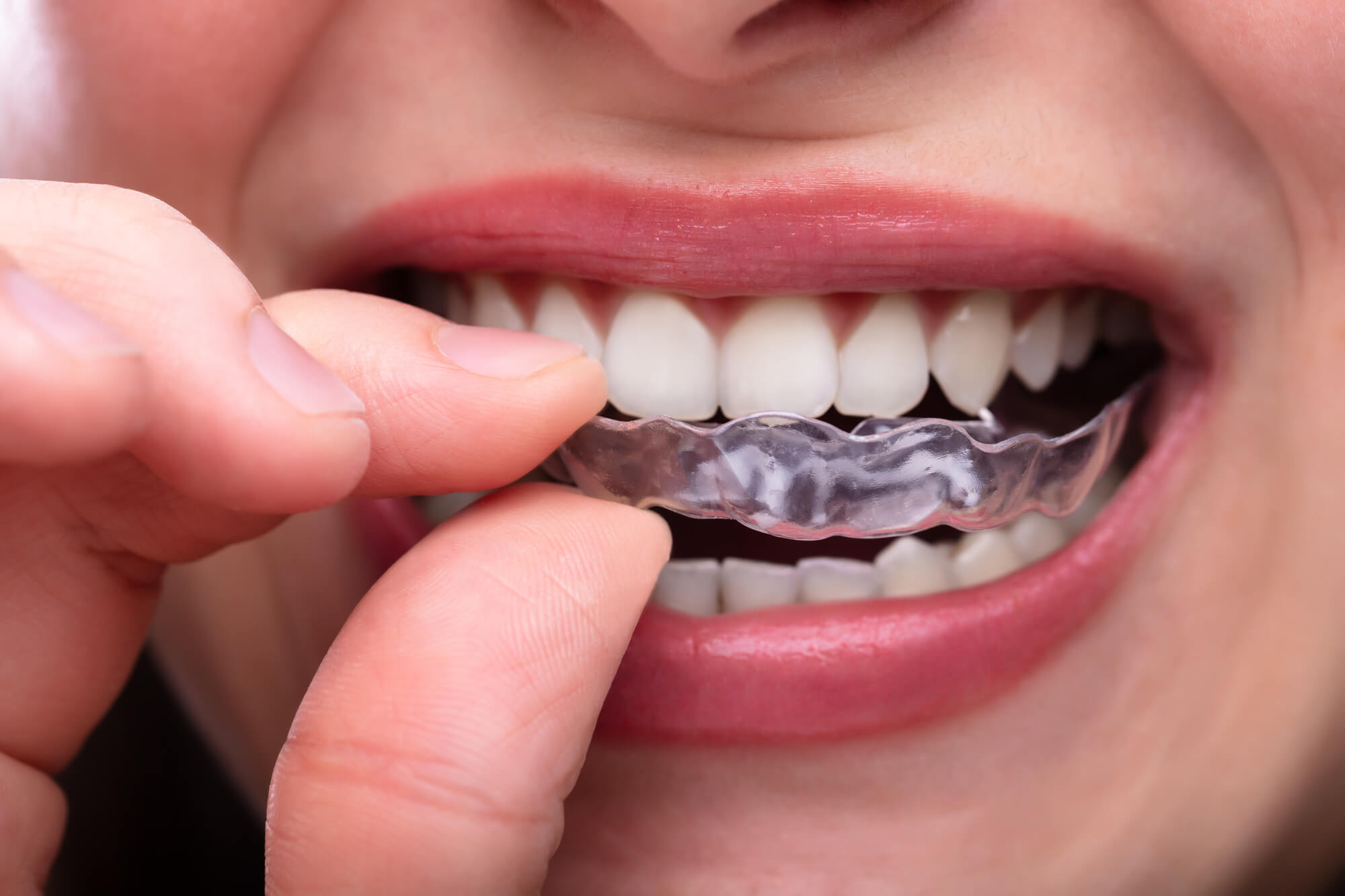Benefits of Clear Aligner/Invisalign Treatment McDonald Orthodontics