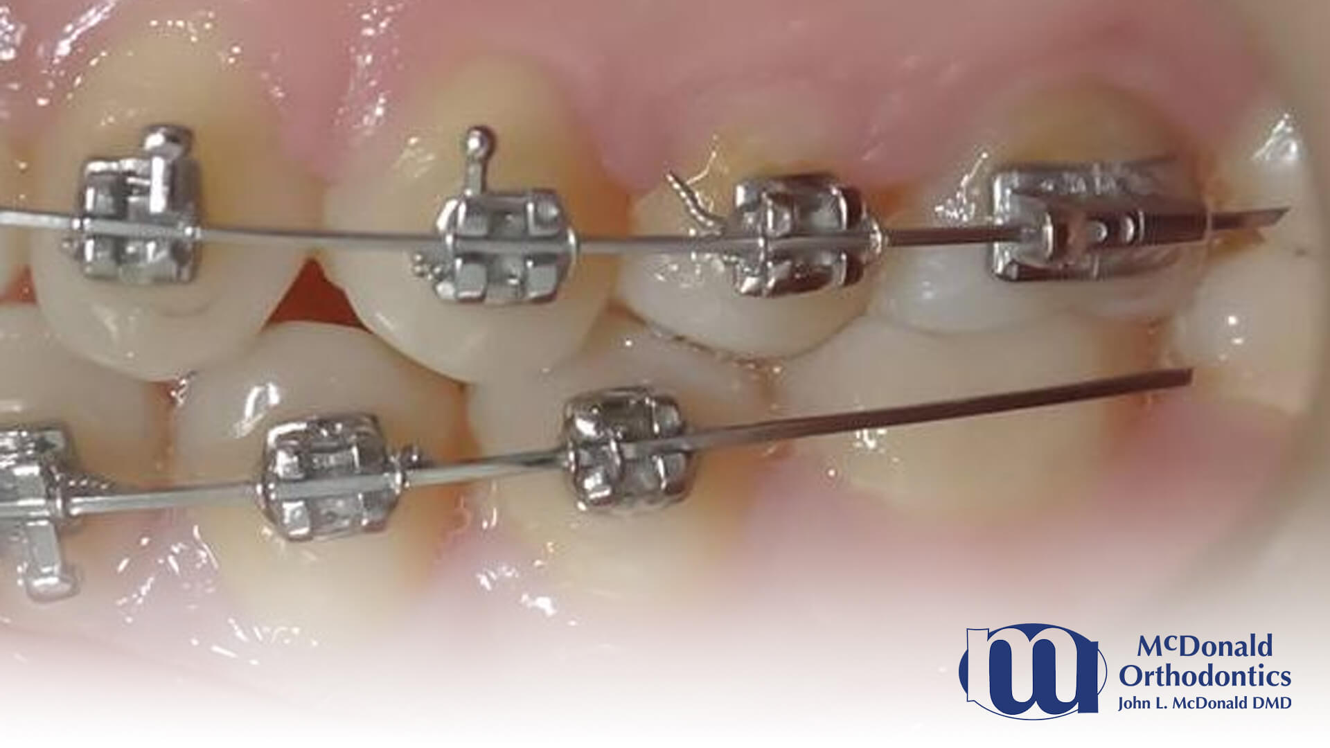 What to Do During an Orthodontic Emergency McDonald Orthodontics