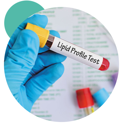Lipid Profile Test Saline Bali