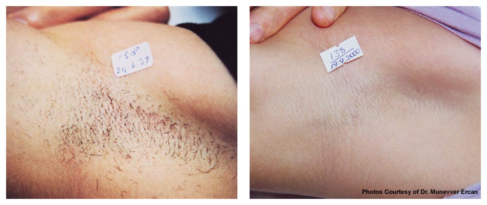 Laser Hair Removal Salonika Medspa
