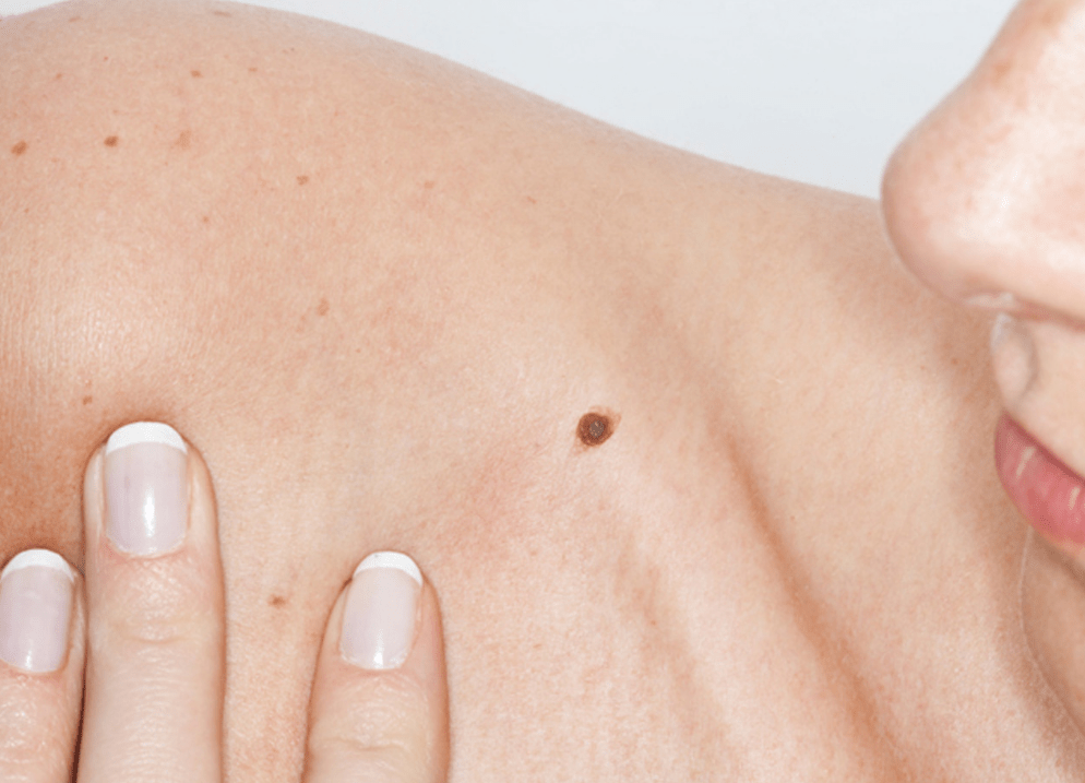 Skin Cancer Centre Brisbane Best Skin Cancer Clinic Brisbane