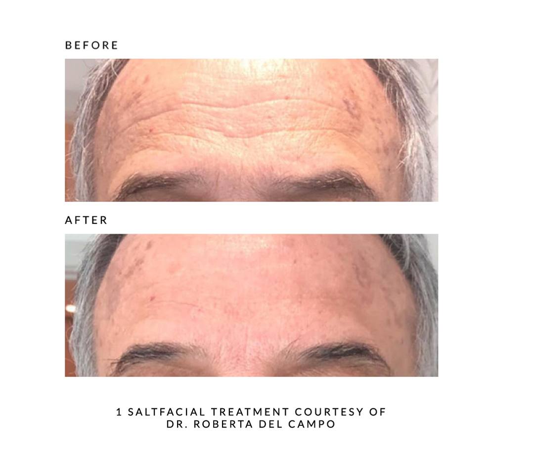 The SaltFacial® Skin Renewal Therapy Treatment By SaltMED